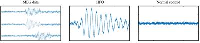 A multi-head self-attention deep learning approach for detection and recommendation of neuromagnetic high frequency oscillations in epilepsy